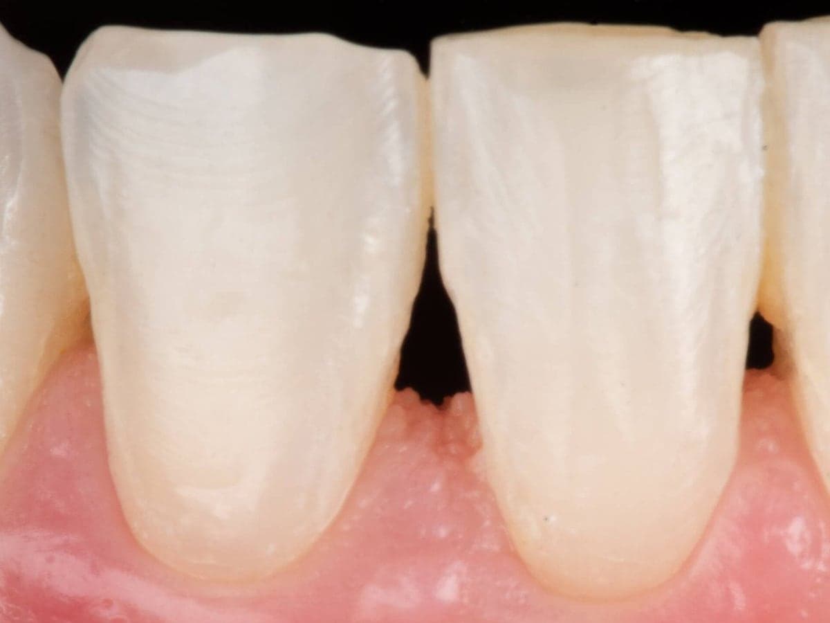 Cierre de diastema inferior — Antes