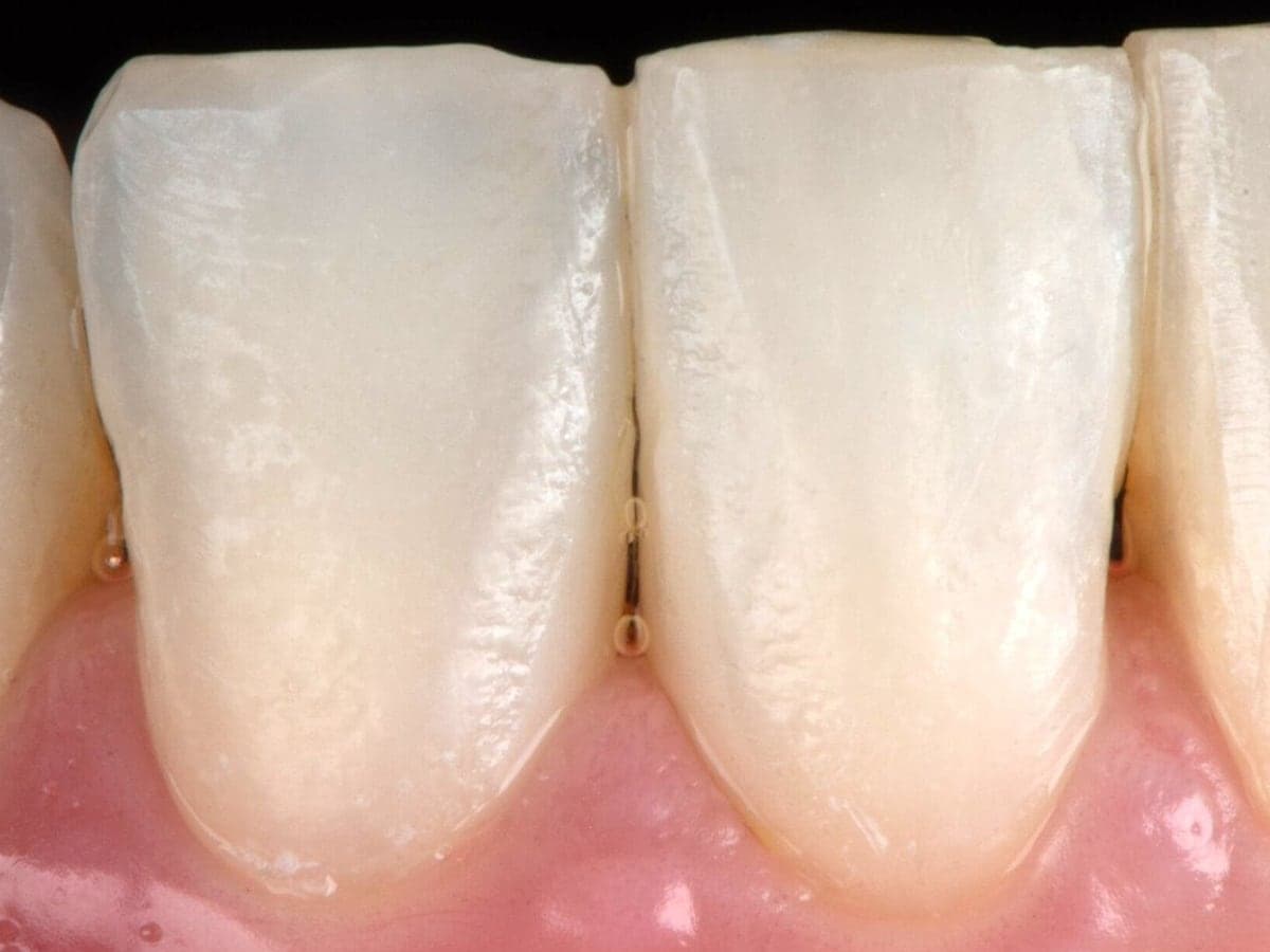 Cierre de diastema inferior — Después