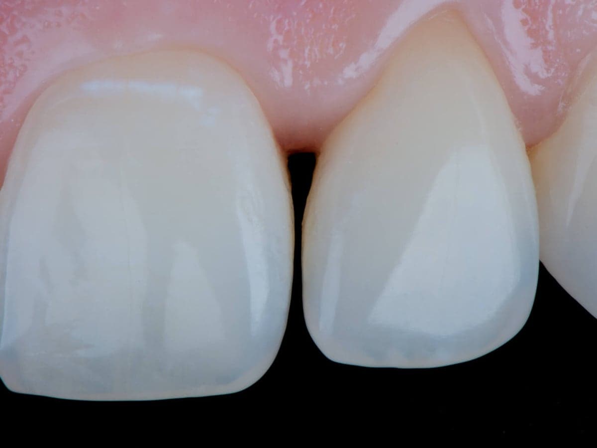 Cierre de diastema superior — Antes