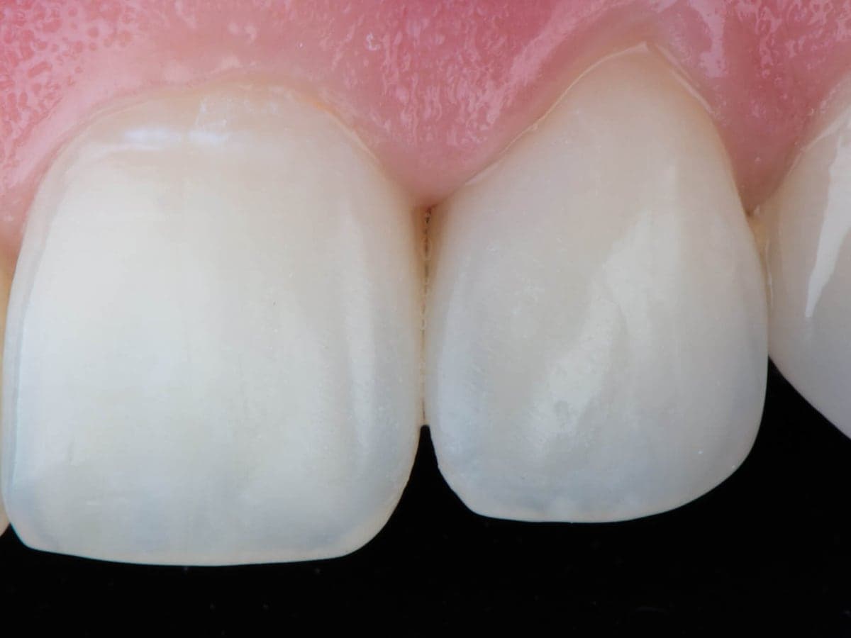 Cierre de diastema superior — Después