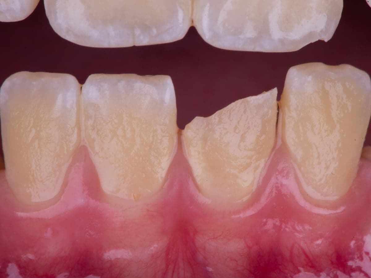 Incisivo fracturado — Antes