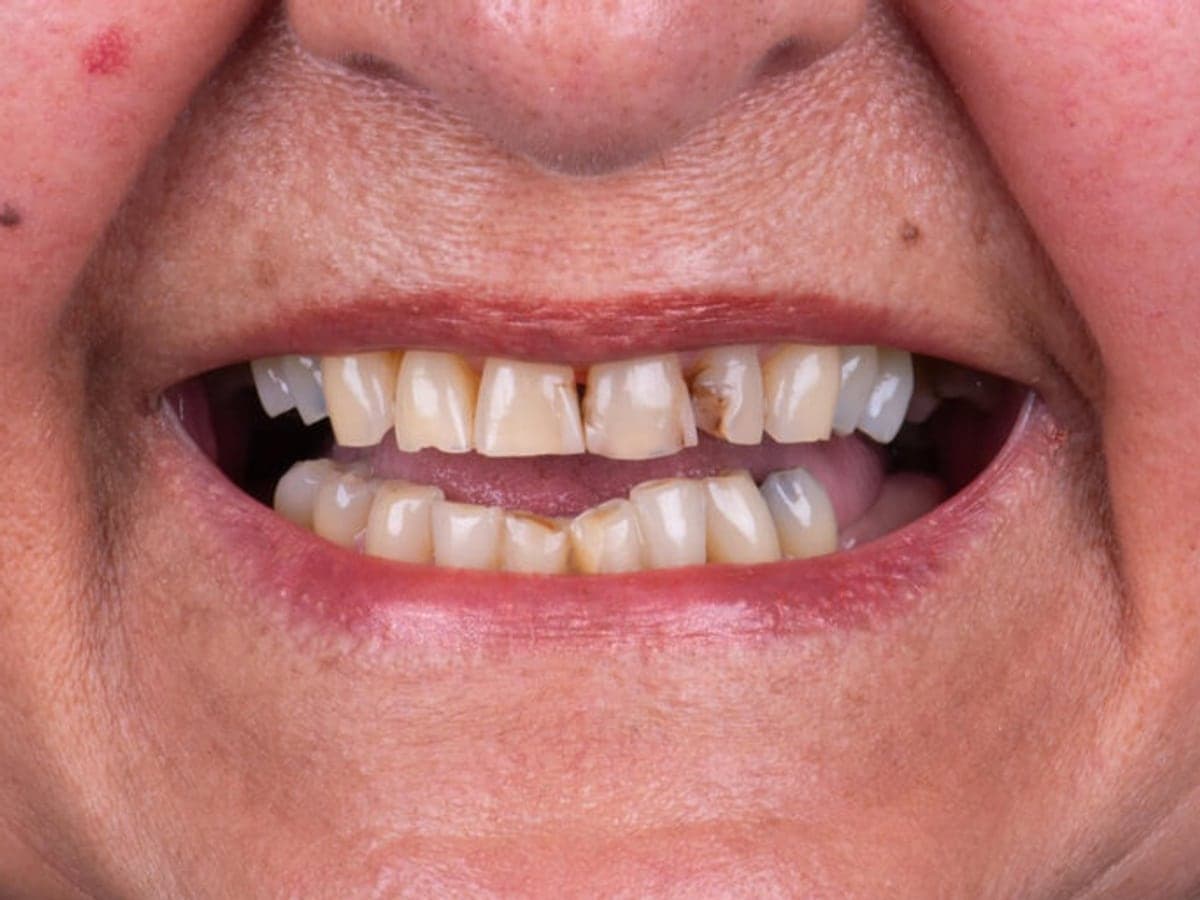 Rehabilitación oral completa — Antes