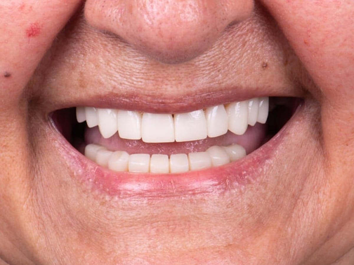 Rehabilitación oral completa — Después